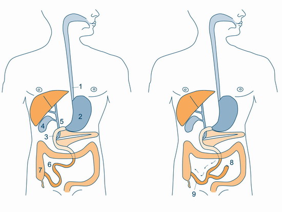Схема операции тонкокишечного шунтирования. Слева - схема пищеварительной системы до операции, справа - после операции.
